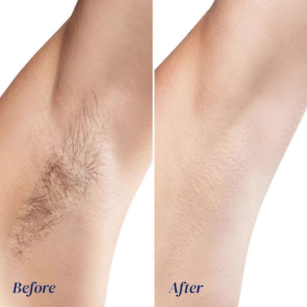 Before and after comparison of underarm hair reduction on a person's arm, with the left side labeled 'Before' showing darker hair and the right side labeled 'After' showing smoother skin.